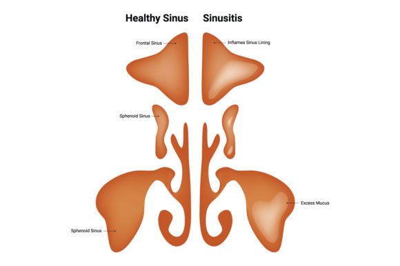 Download Healthy Sinus Sinusitis Science Design - Health Collection